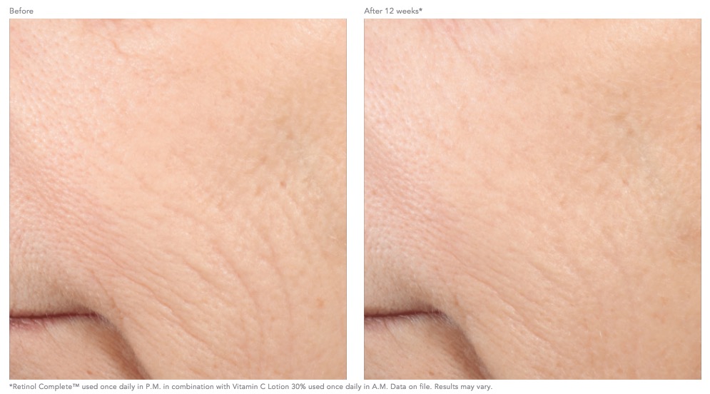 retinol-complete-before-and-after