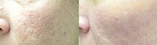 Laser Removal of scars - Yardley Dermatology
