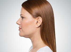 kybella neck treatment by Yardley Dermatology