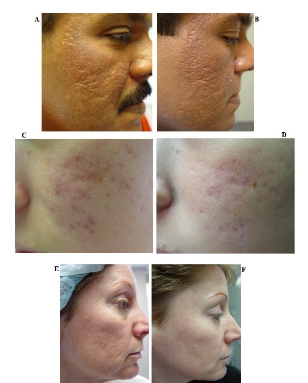 Laser Scar Treatment Yardley Dermatology Associates
